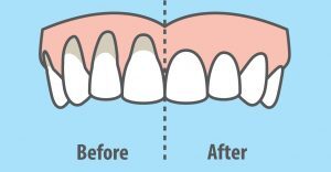 before and after gum treatment