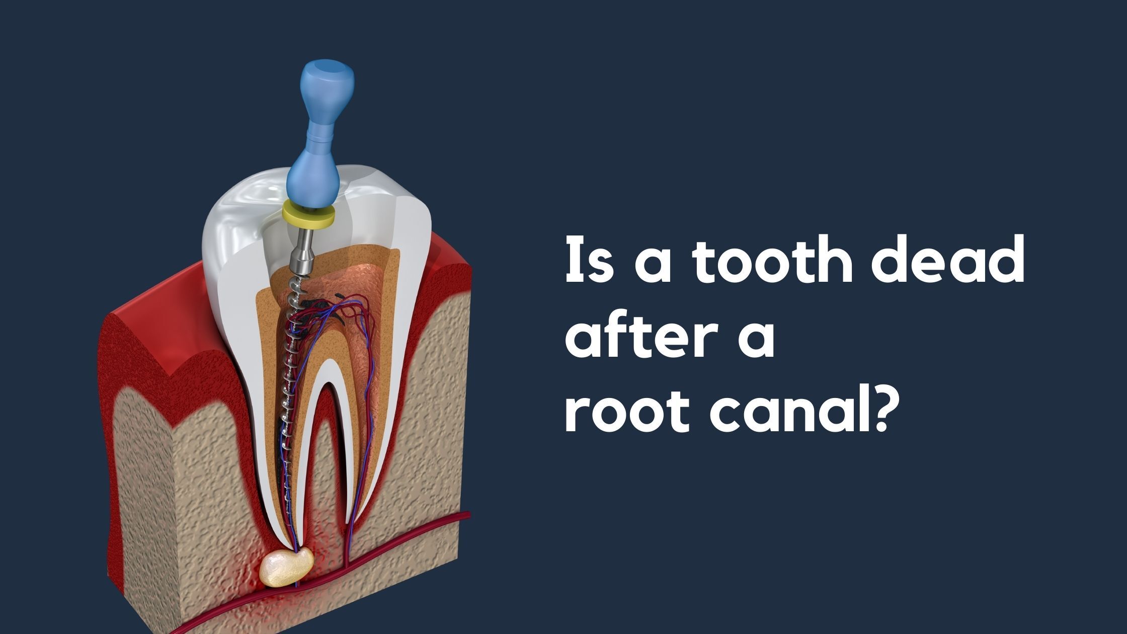 Is a tooth dead after a root canal?